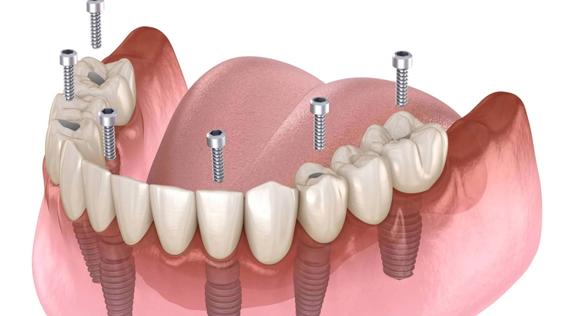 Affordable Dental Implants Near Me