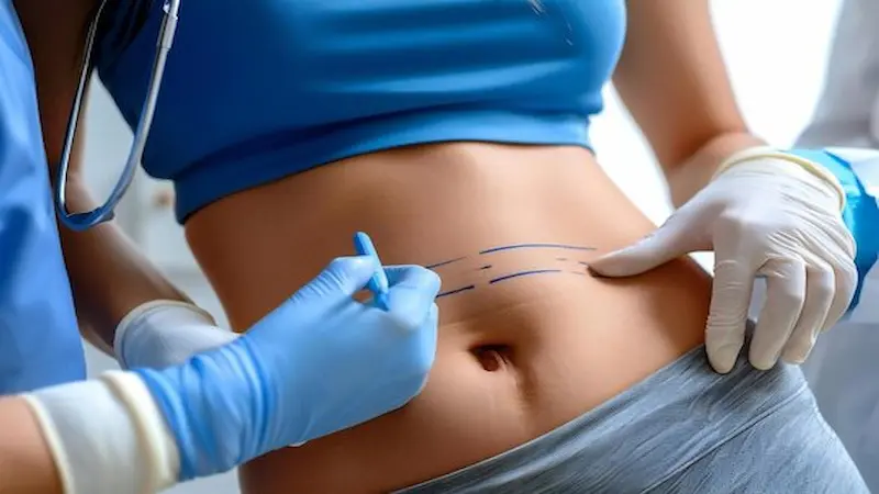 A Step-by-Step Guide to Nearby Tummy Tuck Clinical Trials